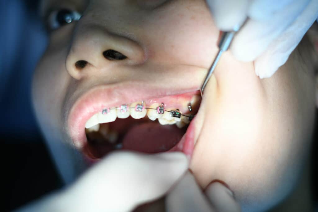 A Teen With Braces On